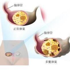 多囊卵巢怎么检查